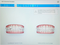 インビザライン　3D画像