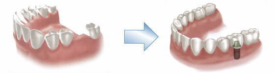 インプラント体１本埋入の場合