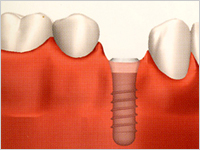 インプラントを埋入